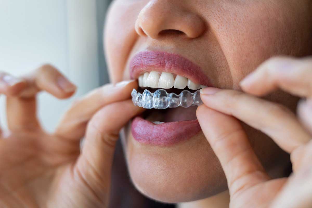 29 Feiten Over Invisalign