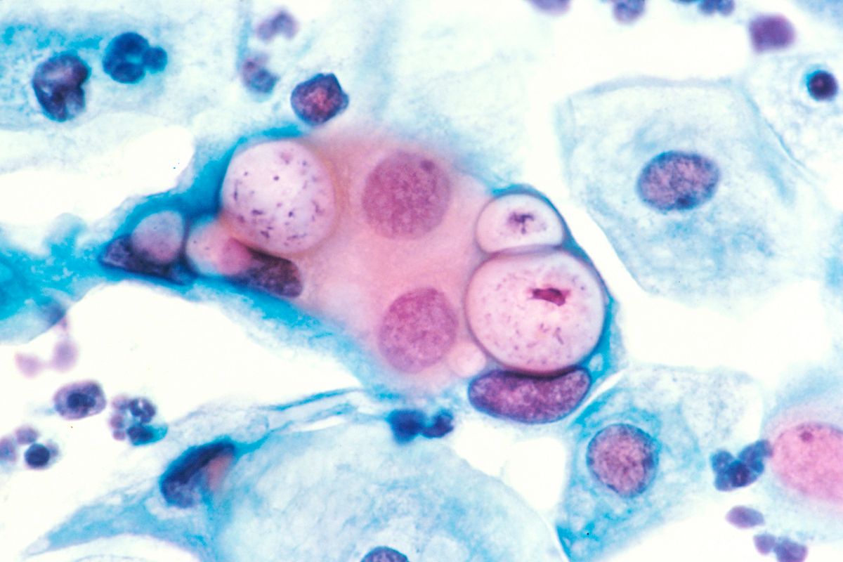 30 Feiten Over Chlamydia