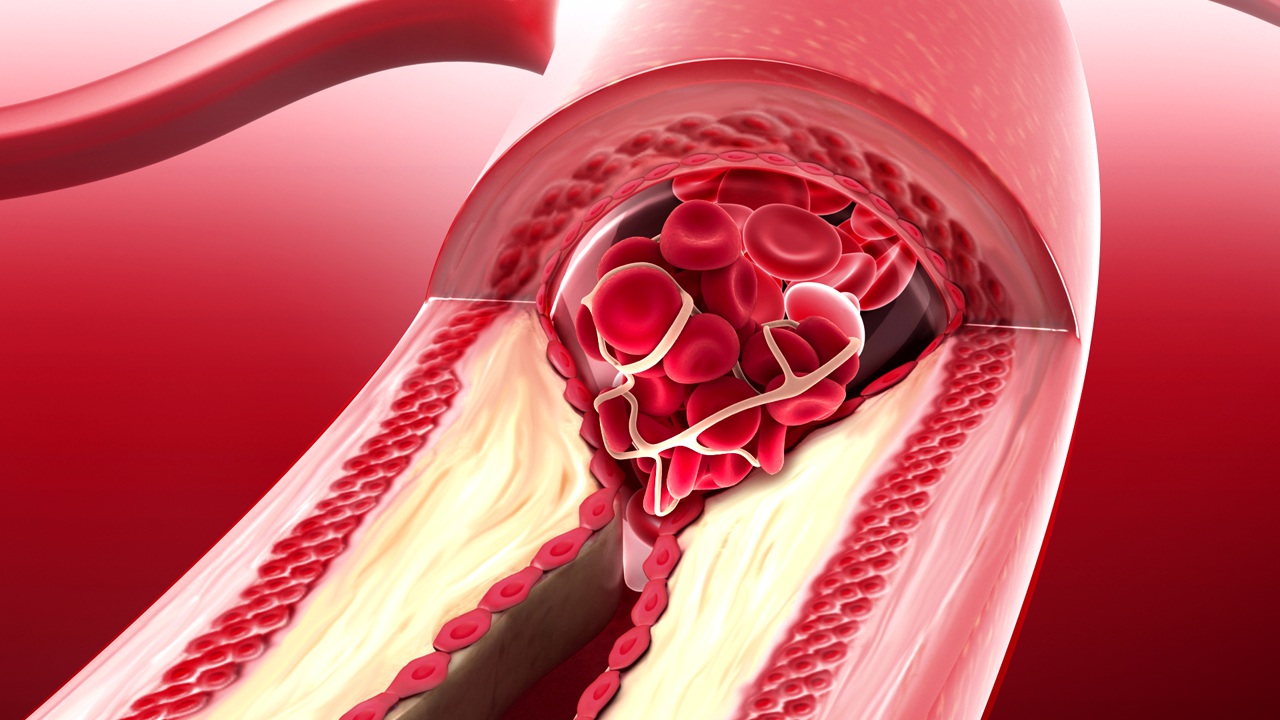 31 Feiten Over Atherosclerose