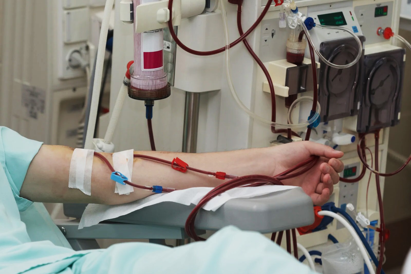 31 Feiten Over Dialyse