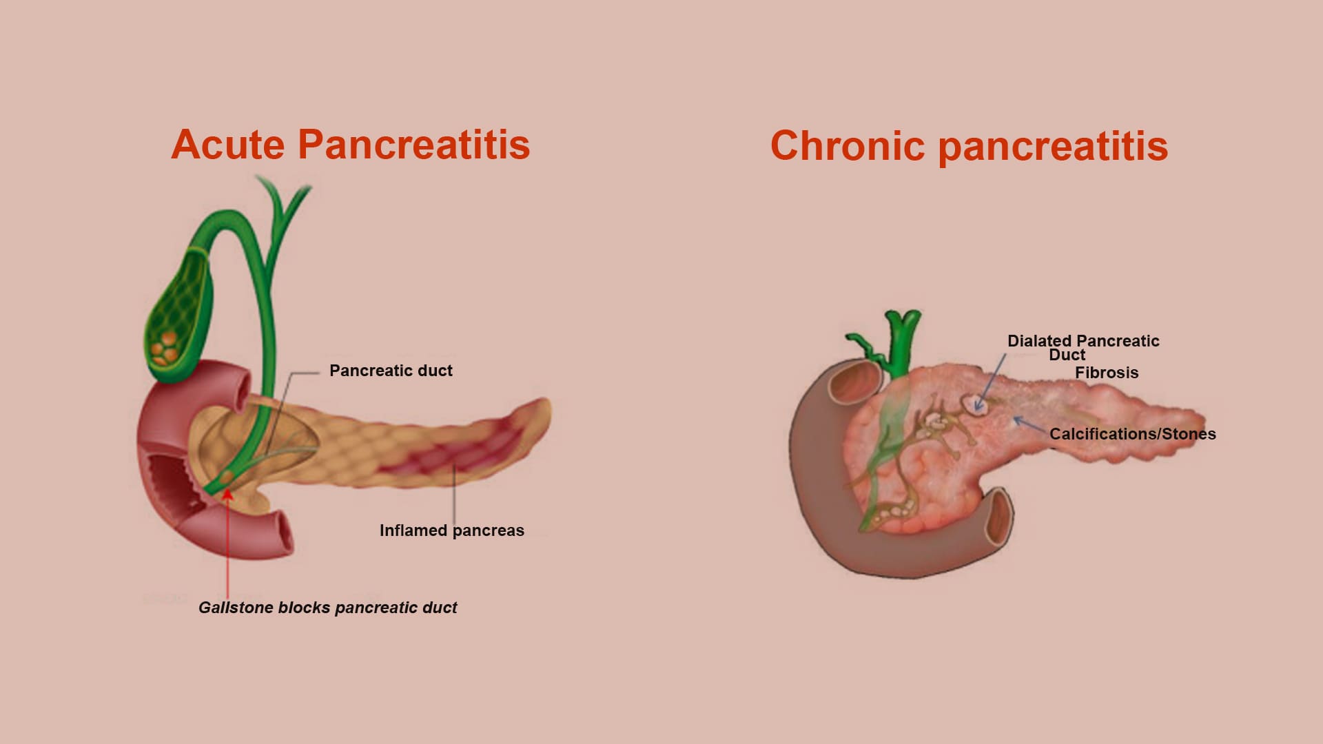 32 Feiten Over Pancreatitis