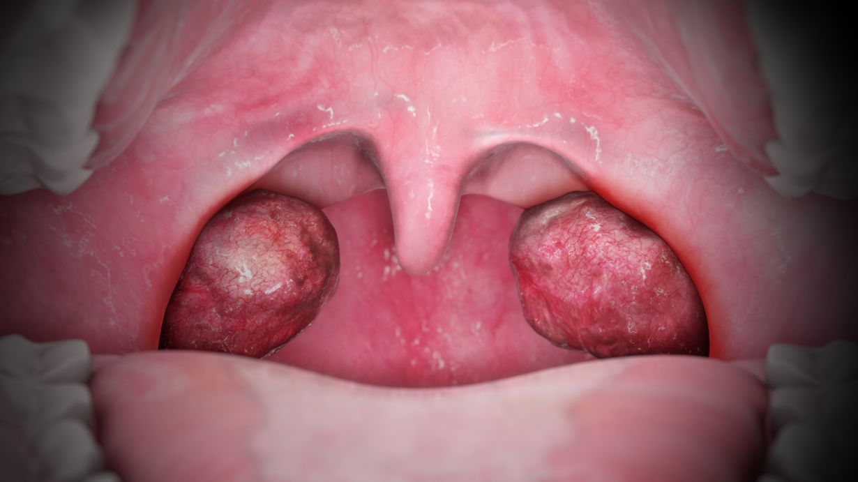38 Feiten Over Tonsillitis