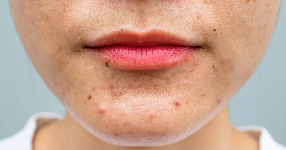 39 Feiten Over Acne